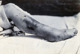 Friern Hospital, London: a child's leg with marks and sores. Photograph, 1890/1910.