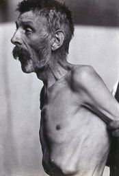Friern Hospital, London: an old man, emaciated, viewed from the side. Photograph, 1890/1910.